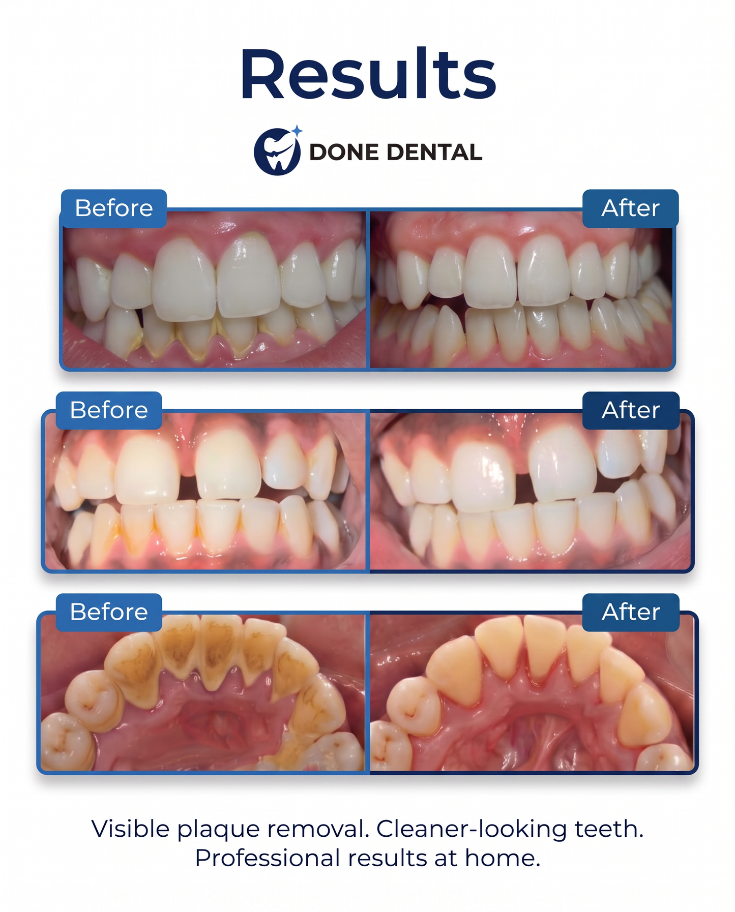 DONEDENTAL™ Plaque and tartar remover