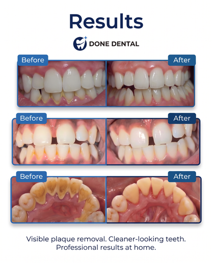 DONEDENTAL™ Plaque and tartar remover